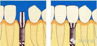 种植牙历史_种植牙历史_种牙的历史有多久
