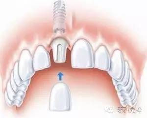 种植牙历史_种植牙历史_种牙的历史有多久