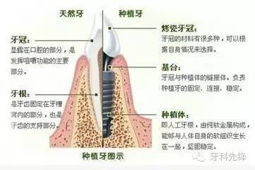 种植牙历史_种植牙历史_种牙的历史有多久