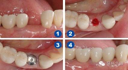 种植牙历史_种牙的历史有多久_种植牙历史