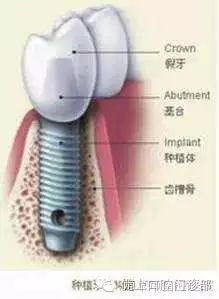 牙齿种植历史_种植牙历史_种植牙历史